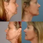 Business 2 image ERNESTO J RUAS MD FACS Tummy Tuck in Tampa FL