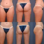 Business 4 image ERNESTO J RUAS MD FACS Tummy Tuck in Tampa FL