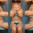 Business 5 image ERNESTO J RUAS MD FACS Tummy Tuck in Tampa FL