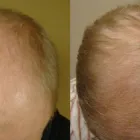 Business 3 image TEMPUS HAIR RESTORATION Hair Replacement in Lake Mary FL