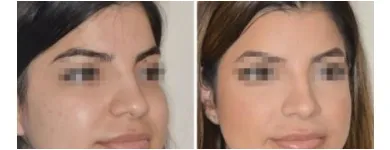 Business 1 image DR. ANTHONY BARED, M.D - FACIAL PLASTIC SURGEON Plastic Surgeons in Maimi FL