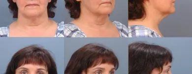 Business 1 image ERNESTO J RUAS MD FACS Tummy Tuck in Tampa FL