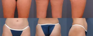 Business 4 image ERNESTO J RUAS MD FACS Tummy Tuck in Tampa FL